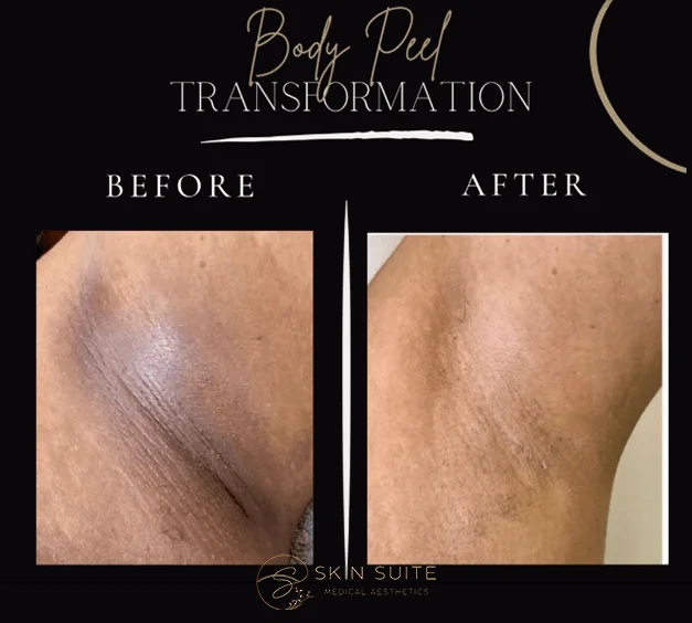 Body peel transformation before and after.