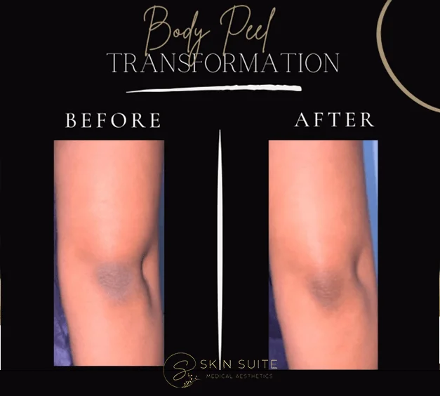 A before and after photo of a body peel transformation.