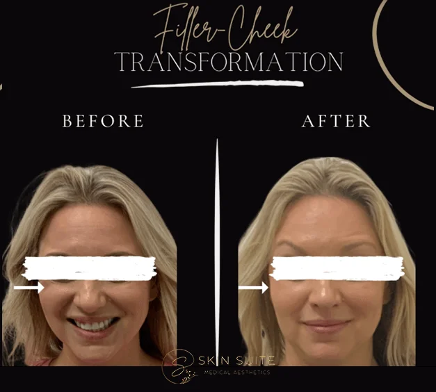 A woman's face before and after a filler check transformation.