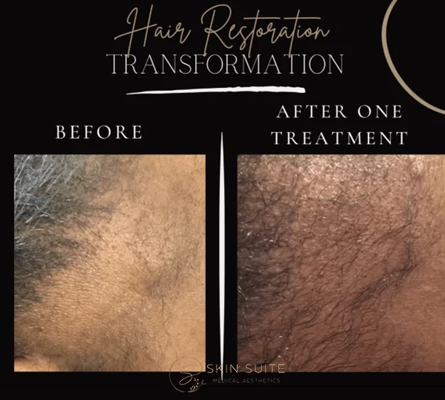 Hair restoration transformation before and after treatment.