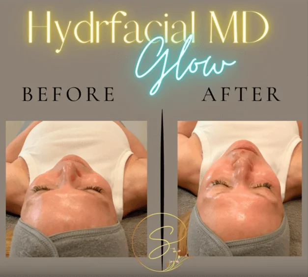 Hydro facial md glow before and after.