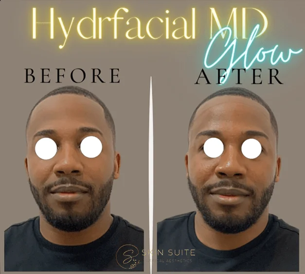 A man's face before and after a hydrofacial md treatment.