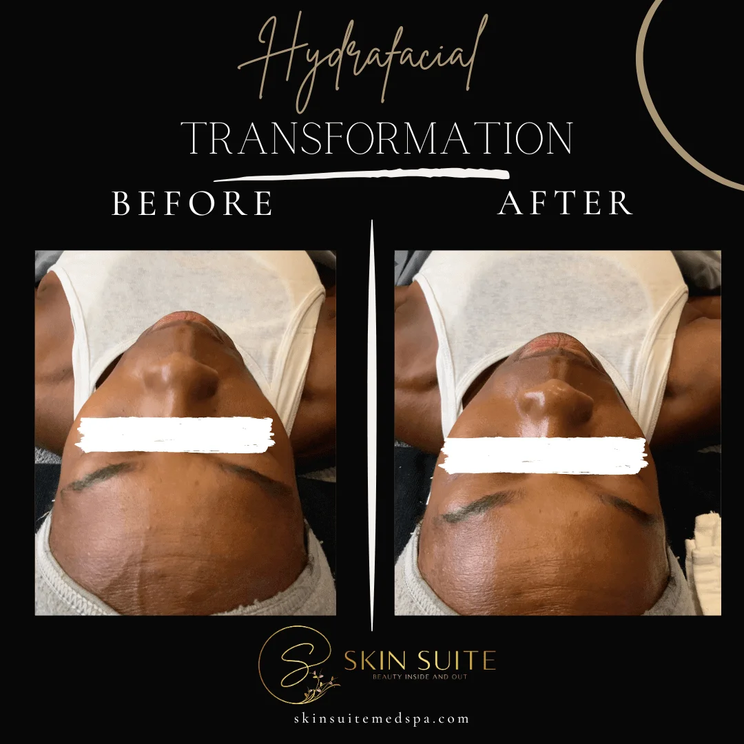 A before and after photo of a hyaluronic acid treatment.