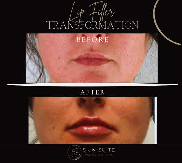 Lip filter transformation before and after.