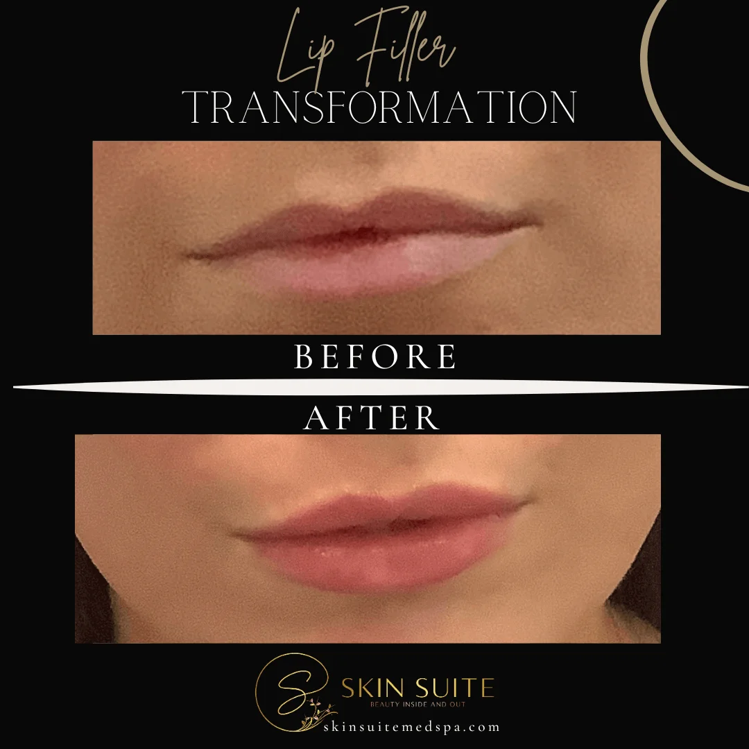 Lip fillers transformation before and after.