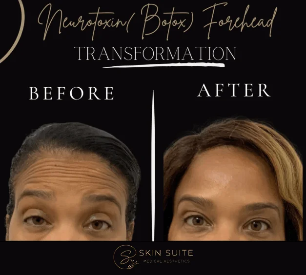 A before and after photo of a woman with wrinkles.