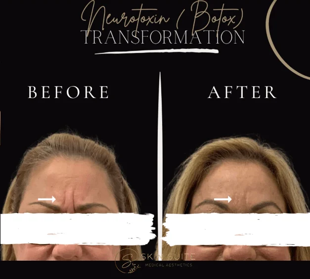 A woman's face before and after a narcolepsy treatment.