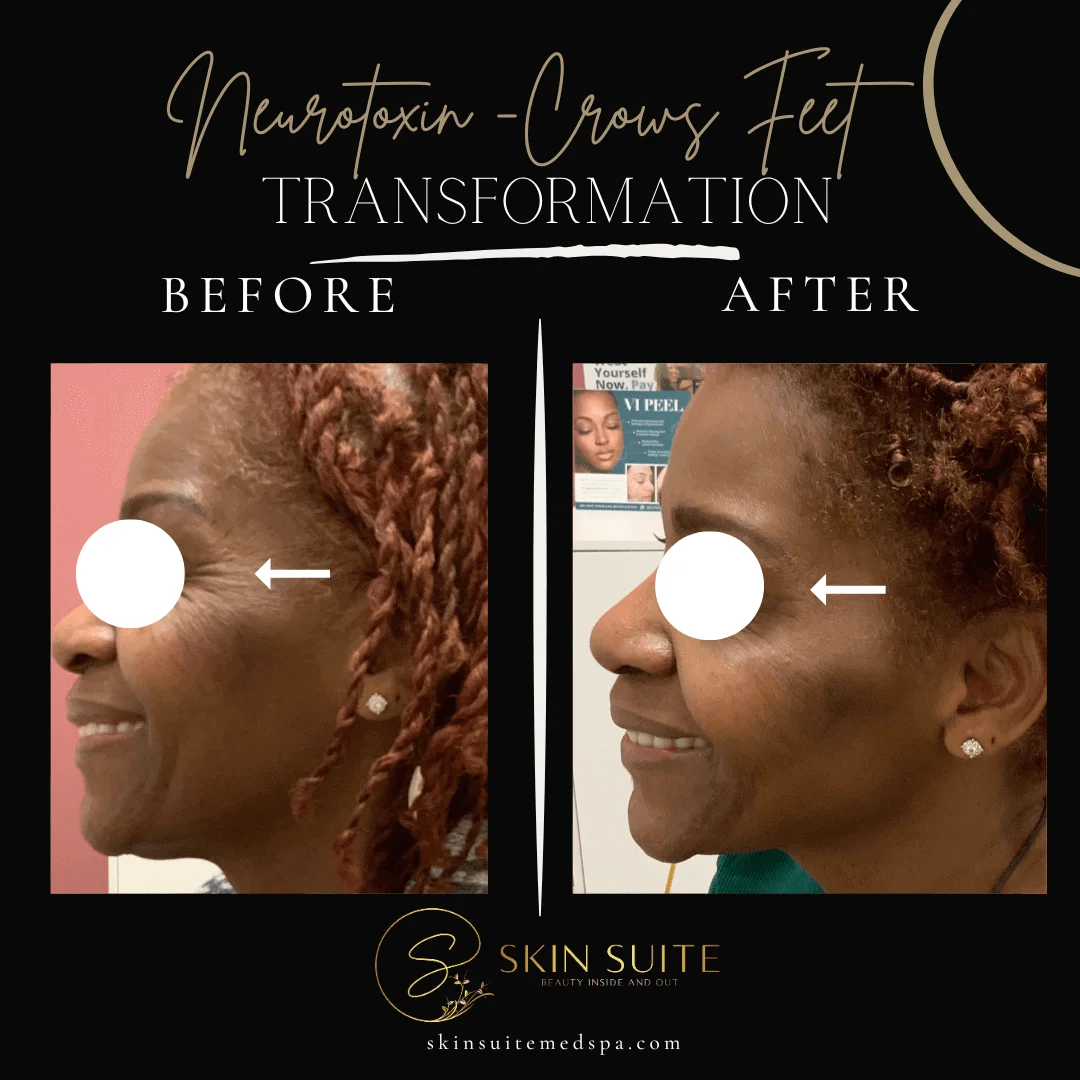 A woman's face before and after a nymphaea crans fist transformation.