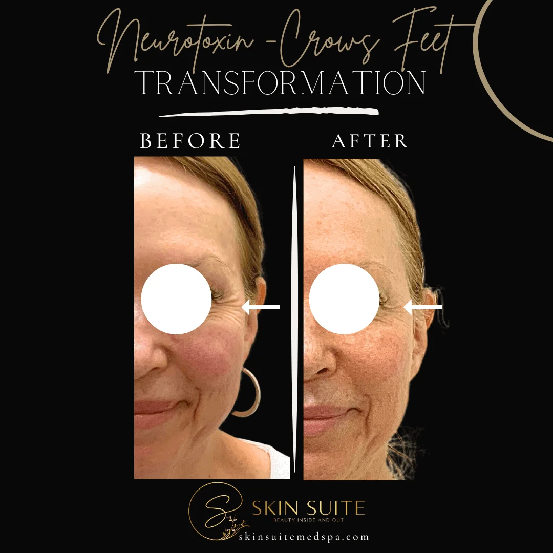 A woman's face before and after a skin treatment.
