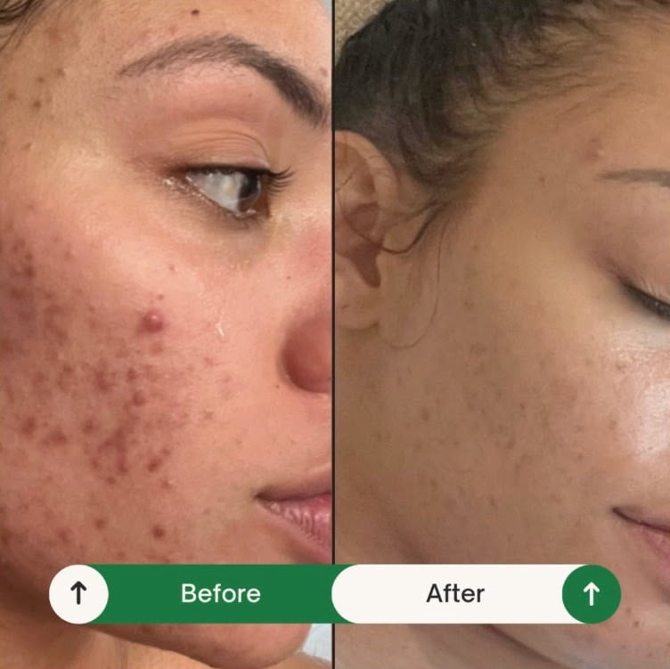 A woman's face before and after acne treatment promotions.