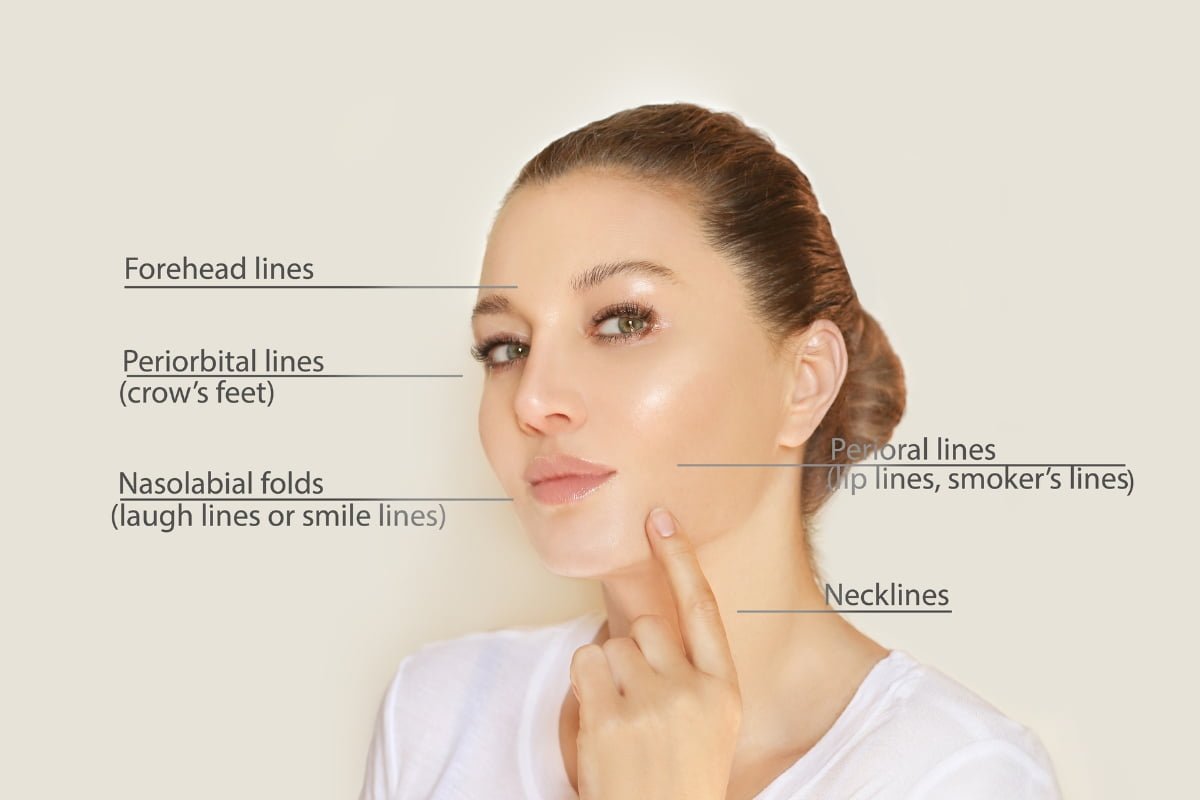 Image of a woman touching her chin, with labels identifying various types of facial lines, including forehead lines, periorbital lines, nasolabial folds, perioral lines, and necklines. The illustration highlights areas where skin fillers can effectively reduce the appearance of these lines.