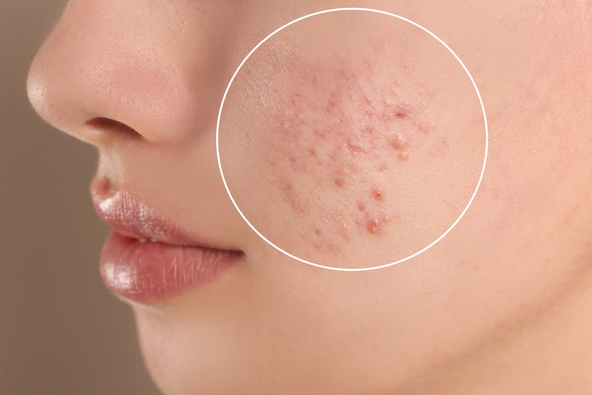 Close-up of a person's cheek with a circled area showing acne and pimple scars. The background is a plain, neutral color, highlighting the potential microneedling benefits for skin rejuvenation.