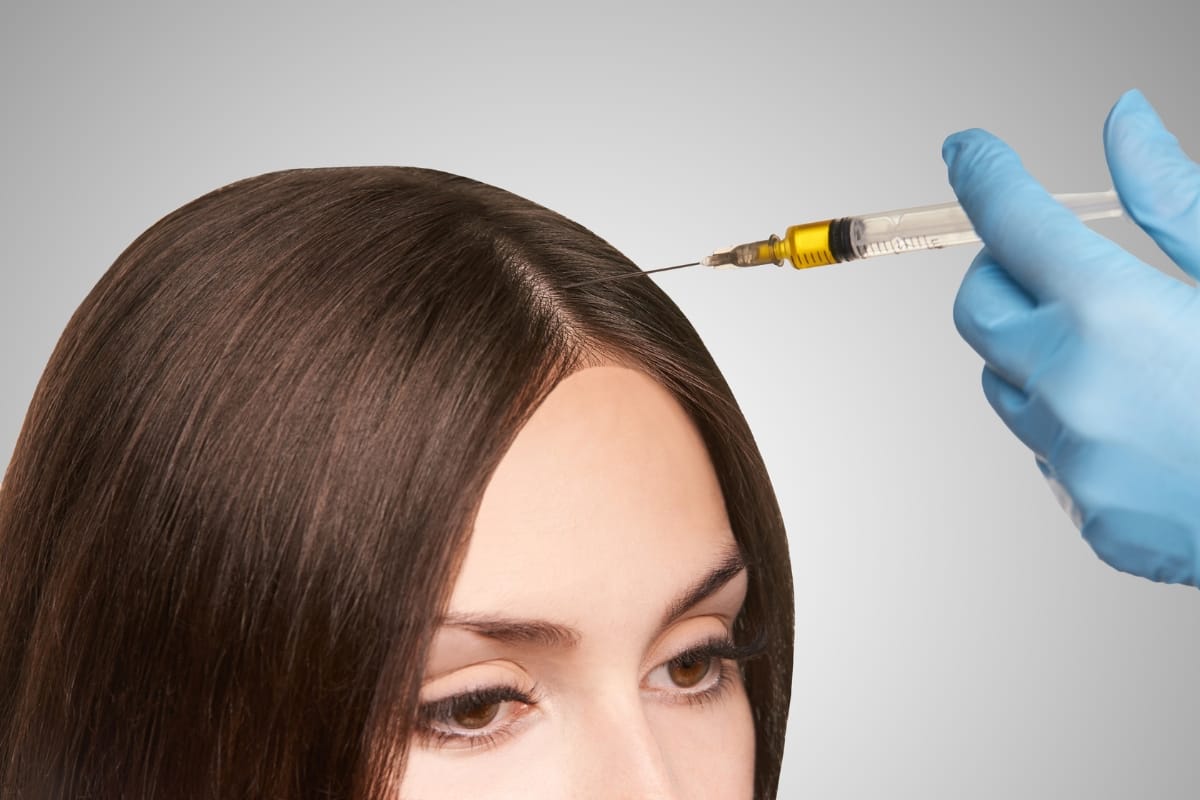 A person with brown hair receives PRP injections in the scalp from a gloved hand.